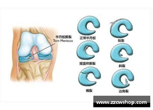 678体育足球星辰的韧性之旅 半月板损伤如何改变了他们的职业生涯